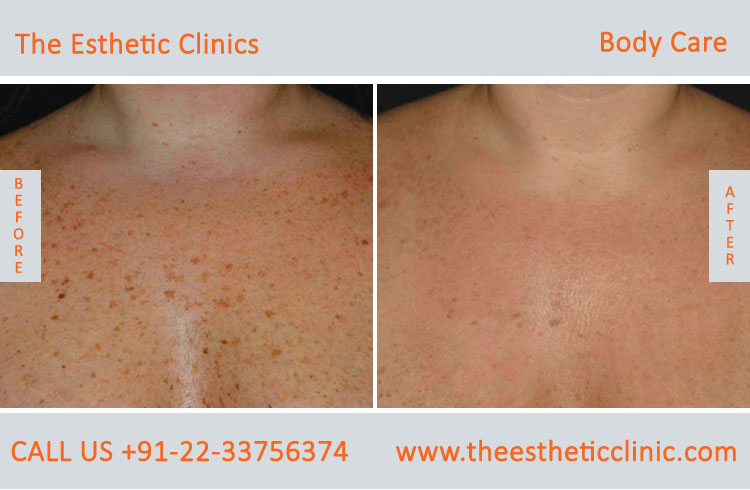 Spider Veins Removal Varicose Veins Laser Treatment before after photos mumbai india 